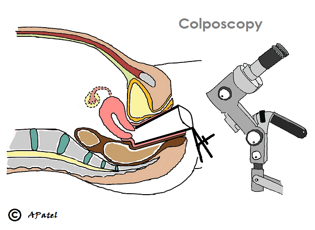 Schematic of Colposcopy