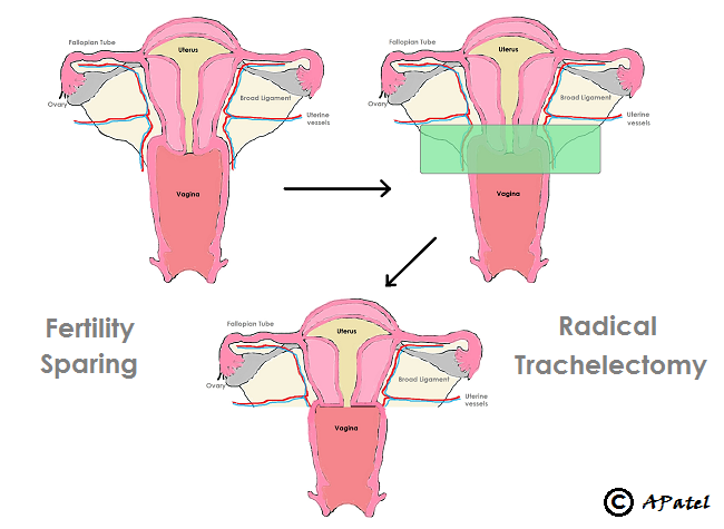 Trachelectomy for cervical cancer