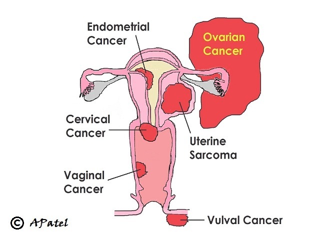 Schematic of gynaecological cancers