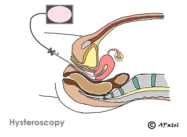 Schematic of Hysteroscopy