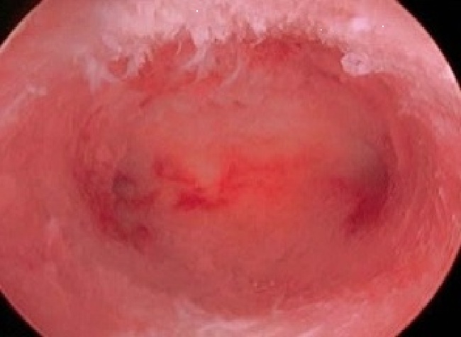 Hysteroscopic view of uterine cavity