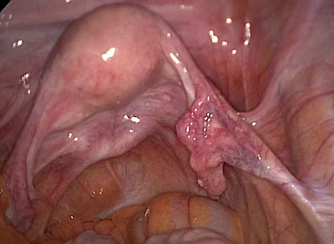 Laparoscopic view of female pelvis