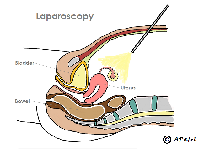 Schematic of Laparoscopy