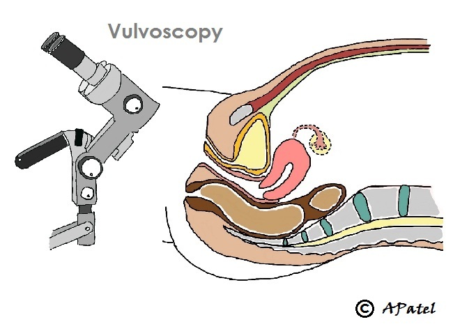 Schematic of Vulvoscopy