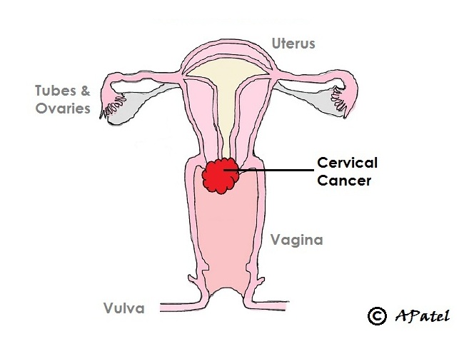 Schematic of cervical cancer