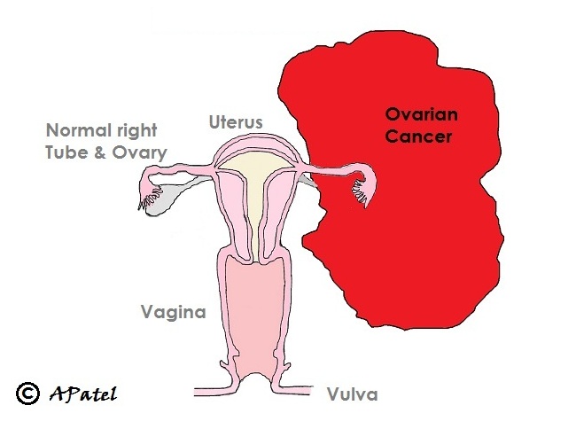 Schematic of ovarian cancer