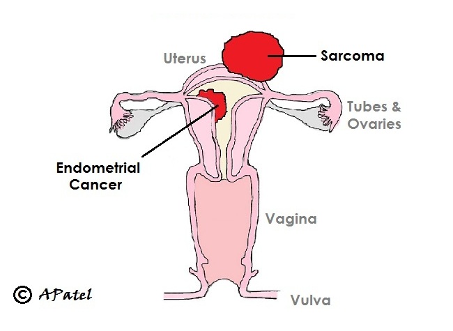 Schematic of uterine cancer