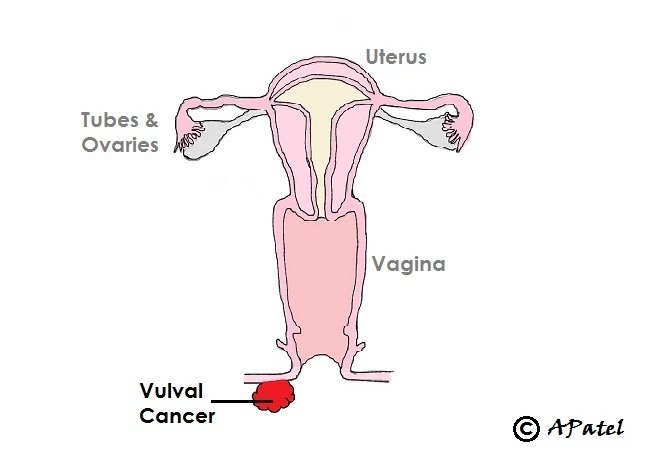 Schematic of vulval cancer